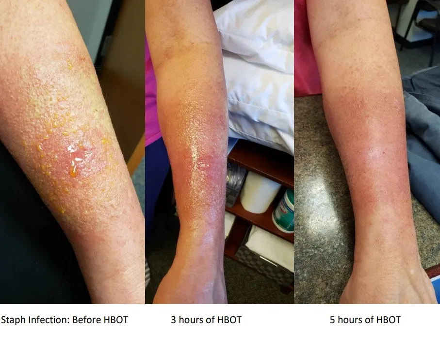 Staph infection improves with hyperbarics at 123HBOT